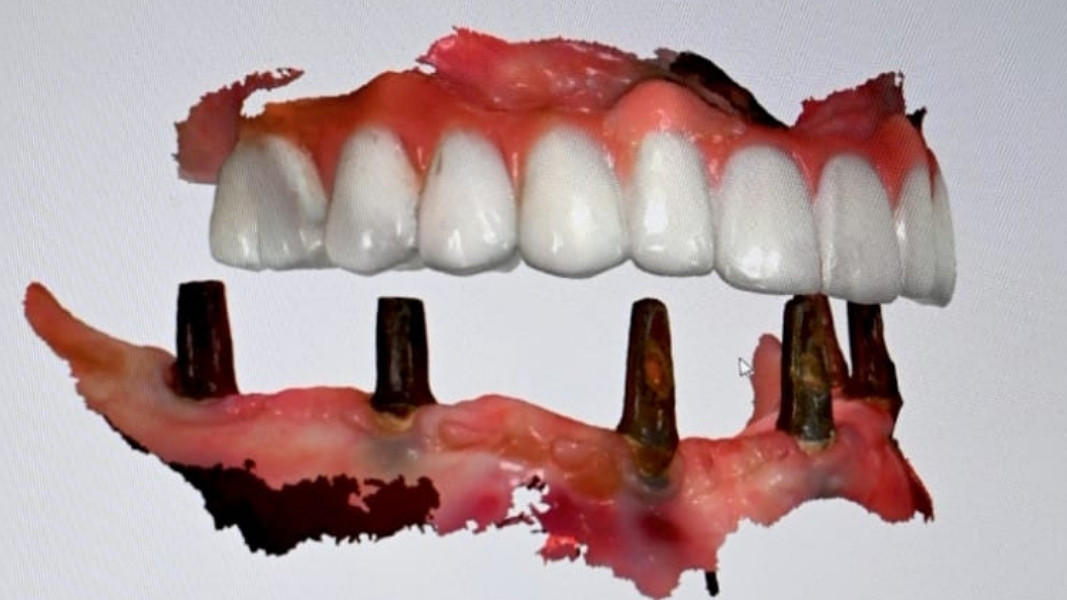 All on 4 implant nedir?