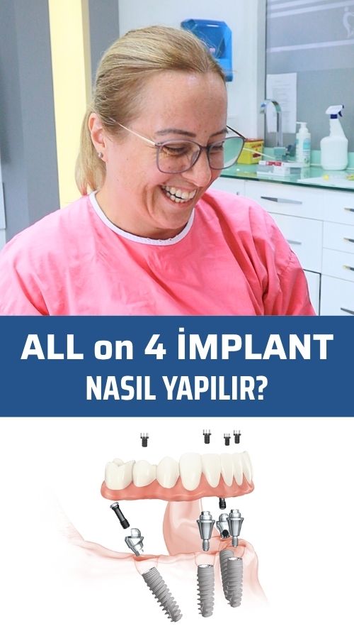 All on Four implant nedir?